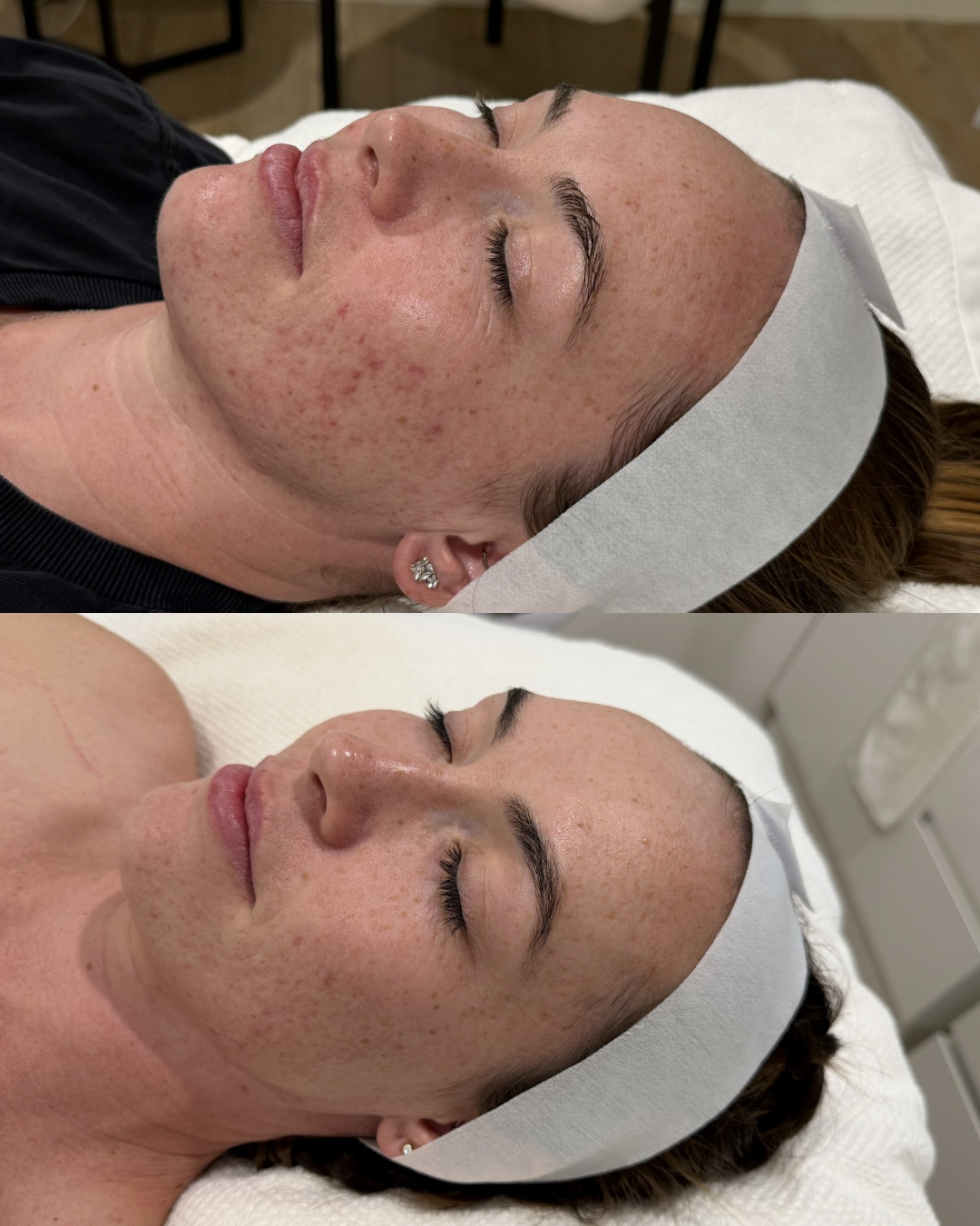 Before and after acne correction treatment for clearer skin in Perth