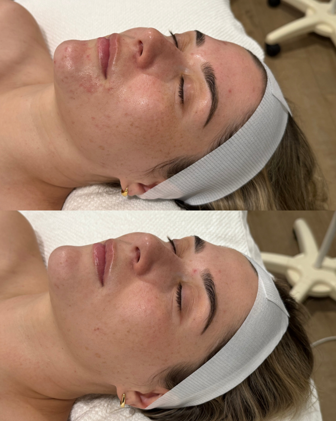 Acne treatment before and after results at The Skin Suite Collective