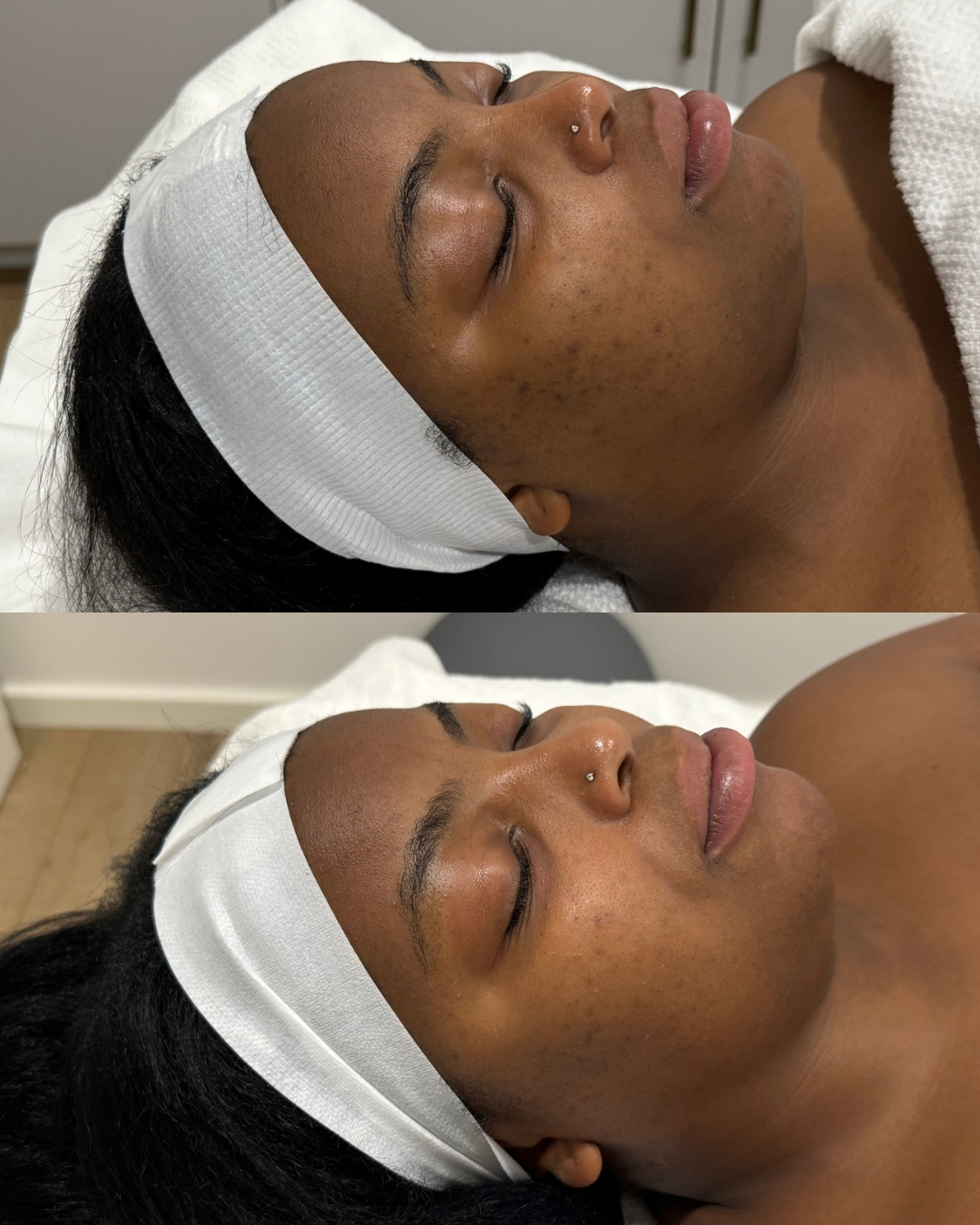 Hyperpigmentation treatment results with improved skin clarity