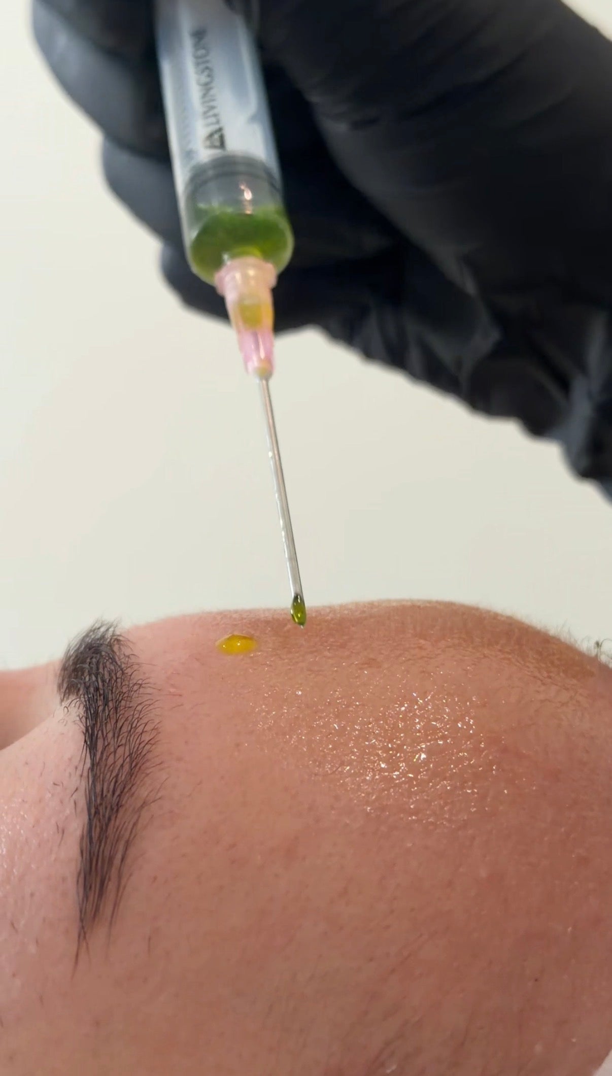 Client receiving a BioRePeel treatment at The Skin Suite Collective to support skin renewal, radiance and overall skin health.